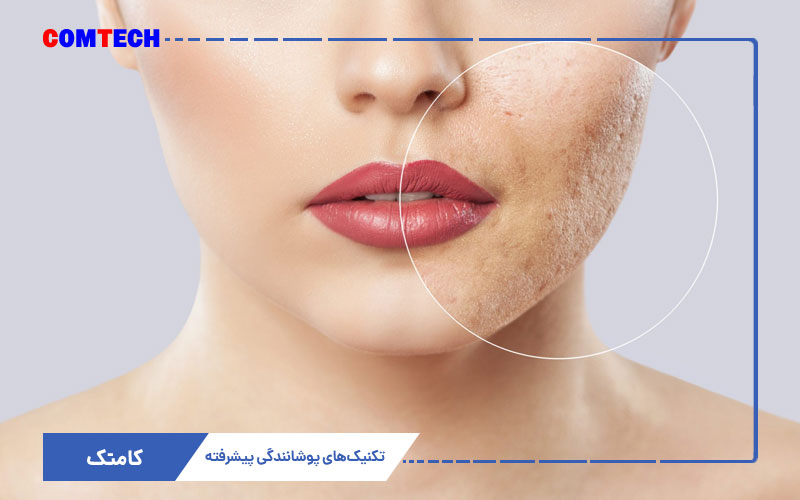 تکنیک پوشانندگی عیوب پوستی