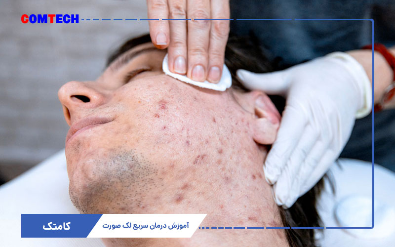 آموزش درمان لک صورت